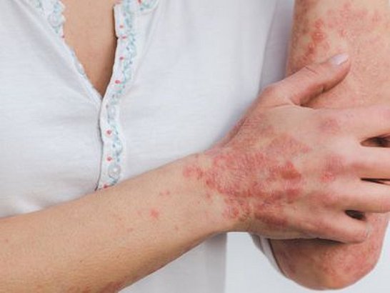 ¿Qué es la psoriasis?