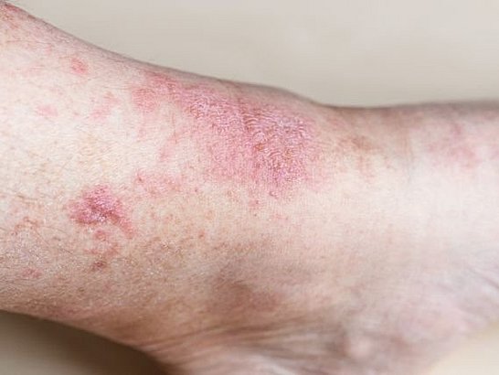 ¿La dermatitis atópica está relacionada con otras afecciones de la piel? 