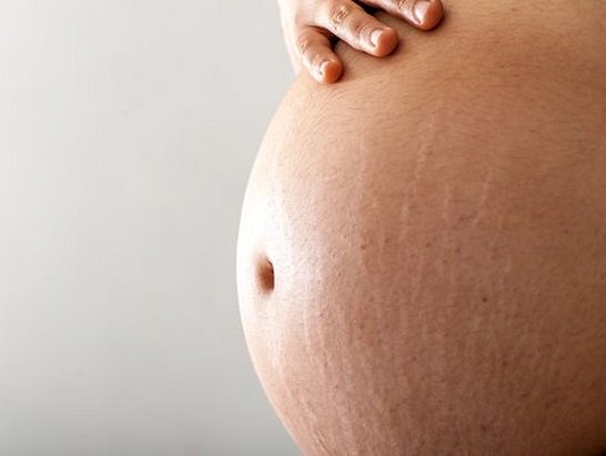 Estrías: Cómo prevenirlas y tratarlas