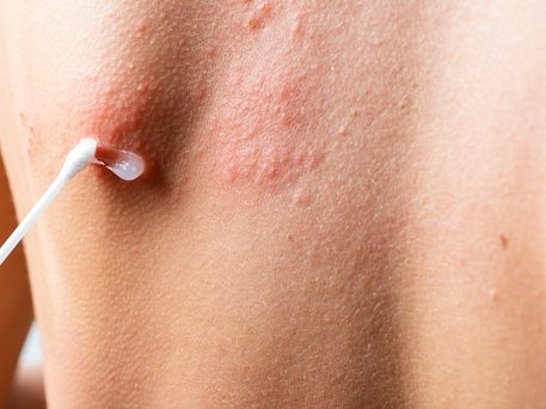 Tratamiento de las Infecciones de la Piel