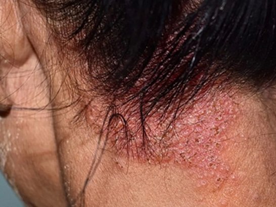 Qué es la dermatitis seborreica