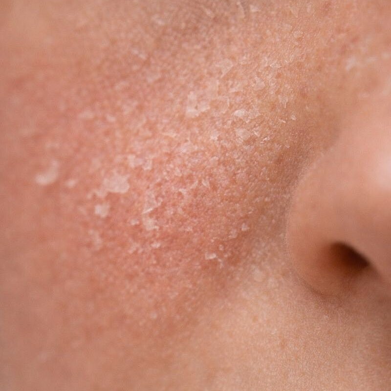 Detalle de piel con ligera descamación y textura irregular