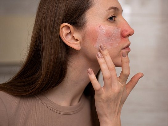 Cuidados cosméticos para piel con rosácea