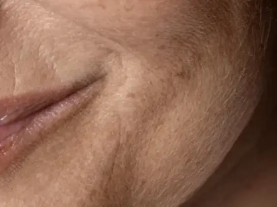 Un primer plano de la cara de una mujer con la piel seca