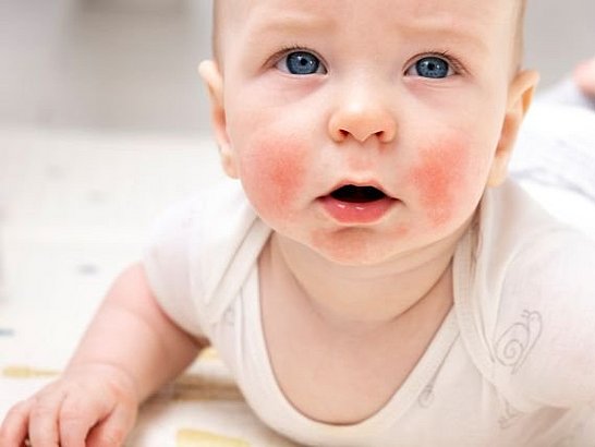 ¿Qué debo hacer si mi hijo tiene dermatitis atópica? 