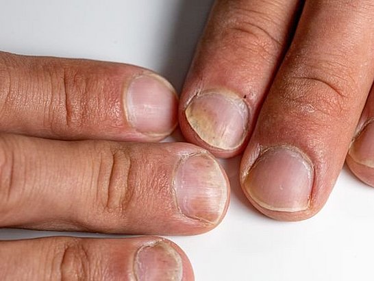 ¿La psoriasis en las uñas es común? 