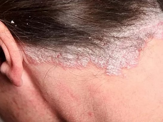 ¿Qué es la Psoriasis del Cuero Cabelludo?